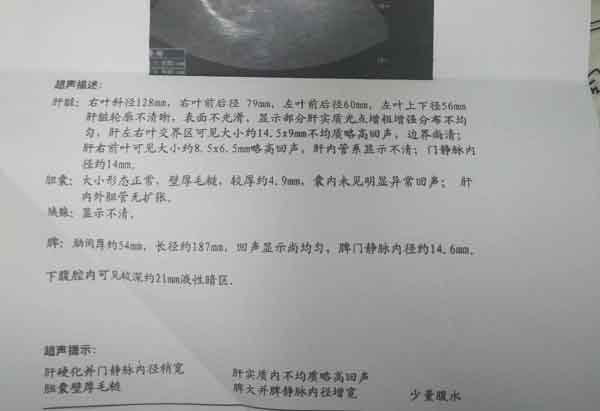 郑州哪儿治疗肝硬化效果好,郑州治疗肝硬化