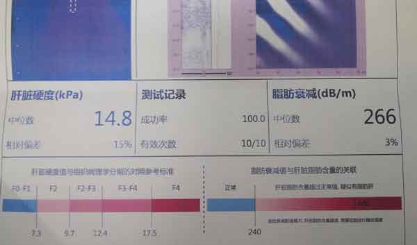 郑州哪儿治疗肝硬化效果好,郑州治疗肝硬化