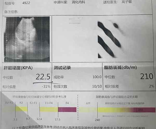 河南省医哪个医生看肝硬化比较好