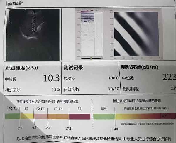 河南省医哪个医生看肝硬化比较好