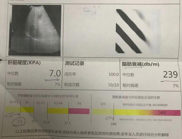 郑州那家肝硬化医院比较好